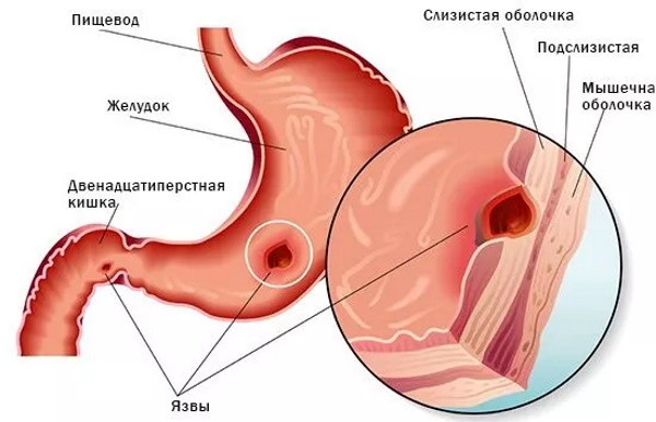 Ph в моче повышен у ребенка. Причины