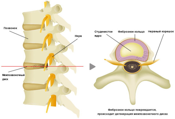 Плазмолифтинг (плазмотерапия) при грыже позвоночника