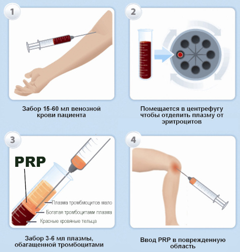 Плазмолифтинг (плазмотерапия) при грыже позвоночника