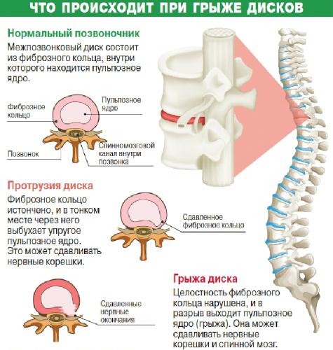 Плазмолифтинг (плазмотерапия) при грыже позвоночника