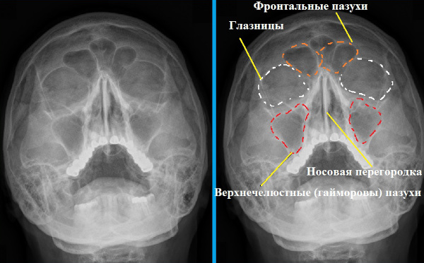 Пневматизация пазух носа. Что это, что значит сохранена, снижение придаточных верхнечелюстных пазух