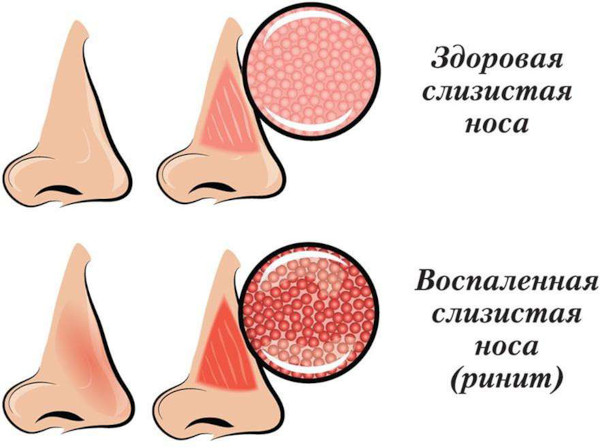 Пневматизация пазух носа. Что это, что значит сохранена, снижение придаточных верхнечелюстных пазух