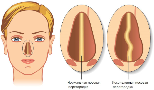 Пневматизация пазух носа. Что это, что значит сохранена, снижение придаточных верхнечелюстных пазух