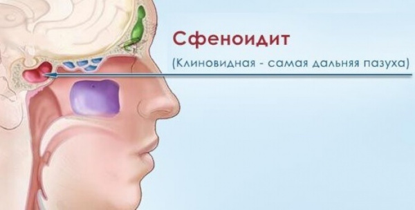 Пневматизация пазух носа. Что это, что значит сохранена, снижение придаточных верхнечелюстных пазух