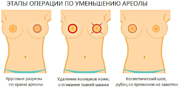 Большие соски и крупные ареолы груди у девушек. Причины