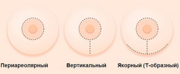 Большие соски и крупные ареолы груди у девушек. Причины