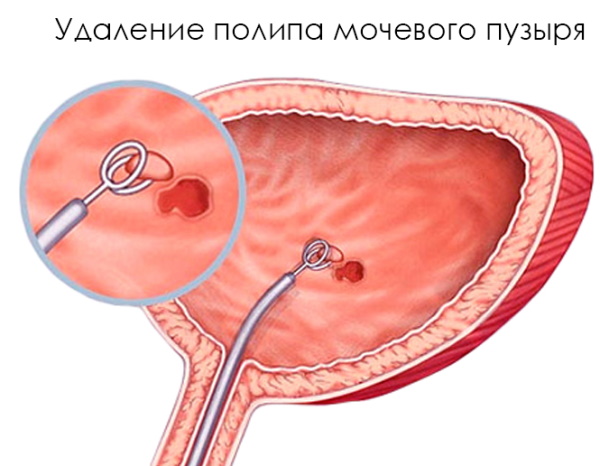 Полип в мочевом пузыре у женщин. Что это, симптомы, лечение