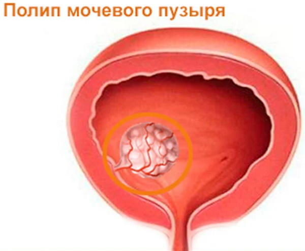 Полип в мочевом пузыре у женщин. Что это, симптомы, лечение