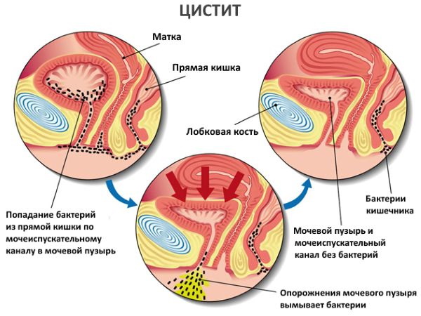 Полип в мочевом пузыре у женщин. Что это, симптомы, лечение