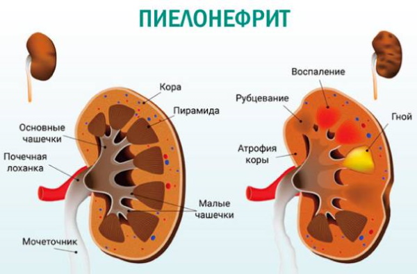 Полип в мочевом пузыре у женщин. Что это, симптомы, лечение