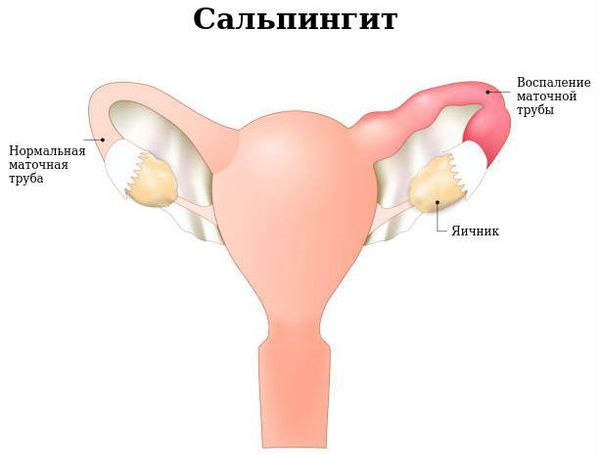 Полип в мочевом пузыре у женщин. Что это, симптомы, лечение