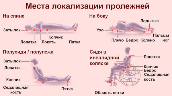 Профилактика пролежней. Что это такое, как выглядят, фото, виды