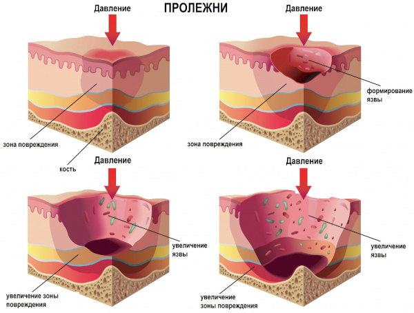 Профилактика пролежней. Что это такое, как выглядят, фото, виды