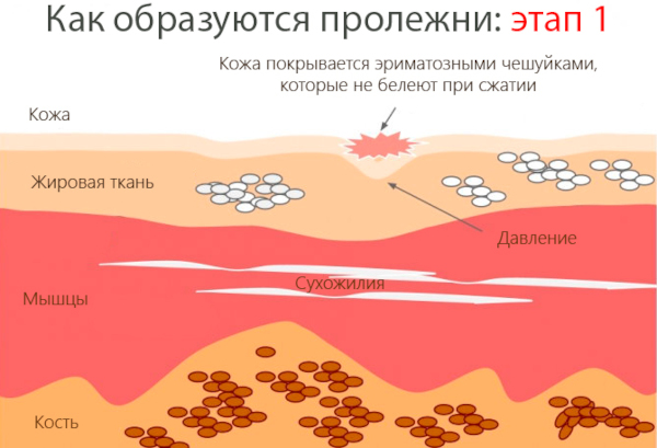 Профилактика пролежней. Что это такое, как выглядят, фото, виды