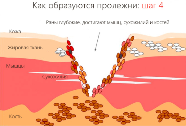 Профилактика пролежней. Что это такое, как выглядят, фото, виды