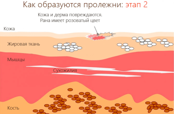 Профилактика пролежней. Что это такое, как выглядят, фото, виды