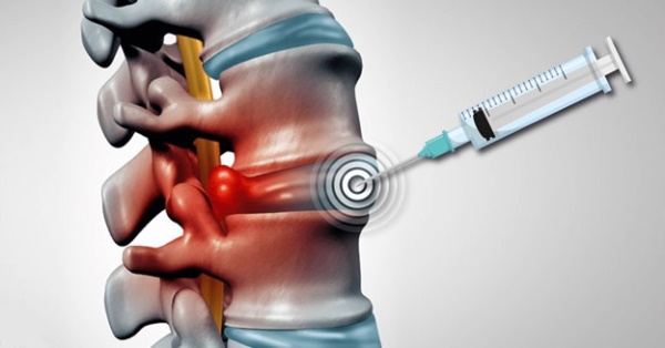Противовоспалительные уколы при болях в спине, пояснице, остеохондрозе
