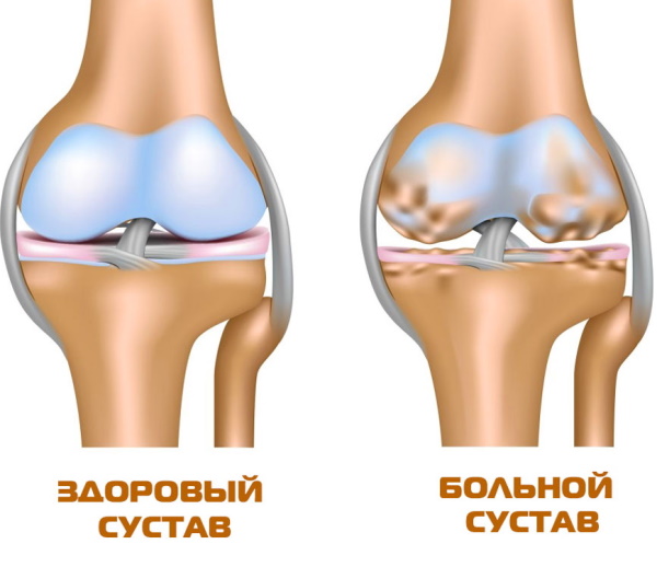 Пункция коленного сустава. Техника выполнения, точки откачки жидкости