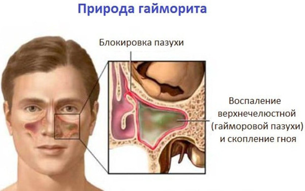 Синус-катетер ЯМИК. Инструкция по применению, цена, отзывы