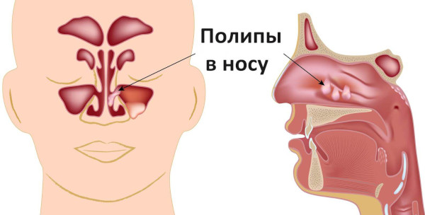 Синус-катетер ЯМИК. Инструкция по применению, цена, отзывы