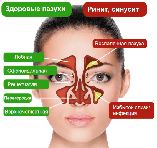 Синус-катетер ЯМИК. Инструкция по применению, цена, отзывы