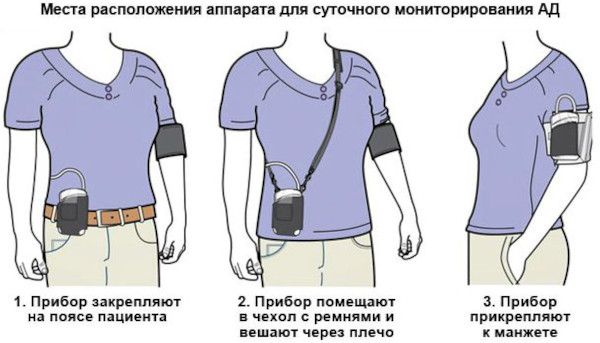 Суточное мониторирование АД (артериального давления). Цена, аппараты