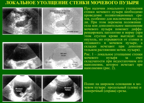 Утолщение стенок мочевого пузыря у женщин, мужчин, ребенка