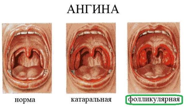 Виды ангины с фото: классификация, формы, какие бывают