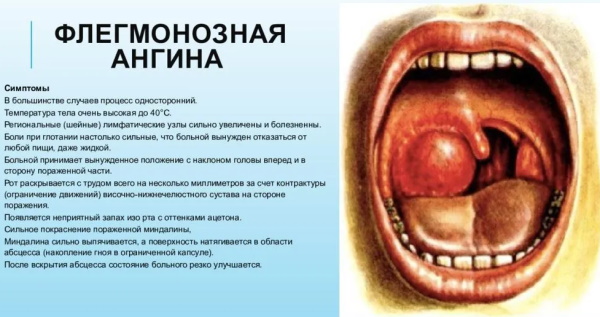 Виды ангины с фото: классификация, формы, какие бывают