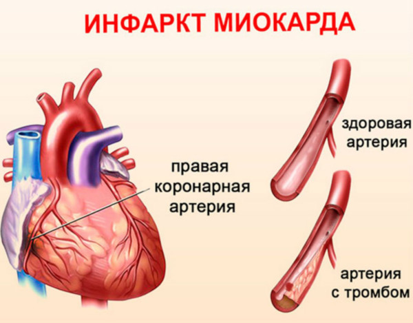 Боли в молочной железе слева у женщин. Причины