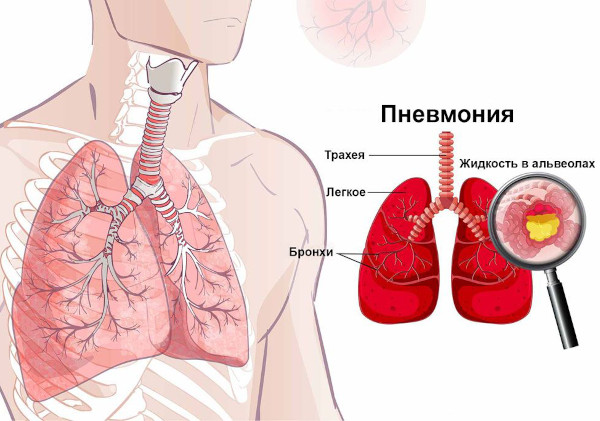 Боли в молочной железе слева у женщин. Причины