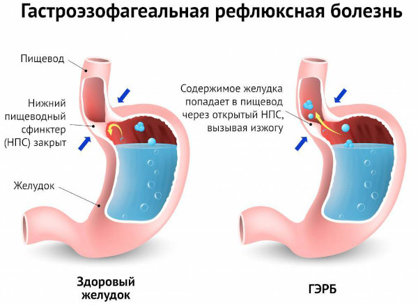 Боли в молочной железе слева у женщин. Причины