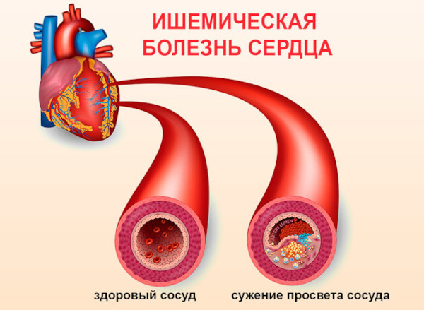 Боли в молочной железе слева у женщин. Причины