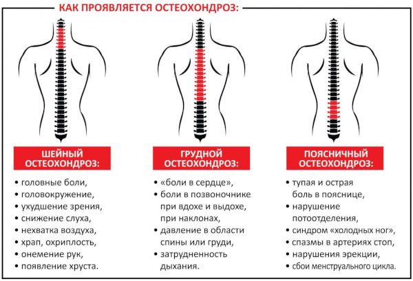 Остеохондроз: степени 1-2-3, стадии, виды, классификация по периодам