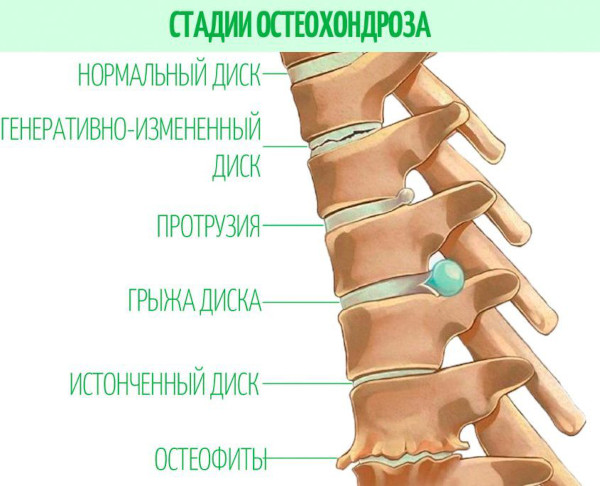 Остеохондроз: степени 1-2-3, стадии, виды, классификация по периодам