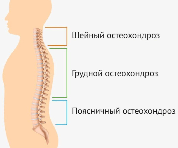 Остеохондроз: степени 1-2-3, стадии, виды, классификация по периодам