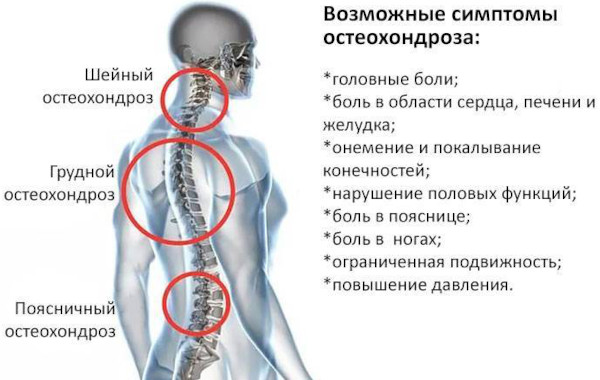 Остеохондроз: степени 1-2-3, стадии, виды, классификация по периодам