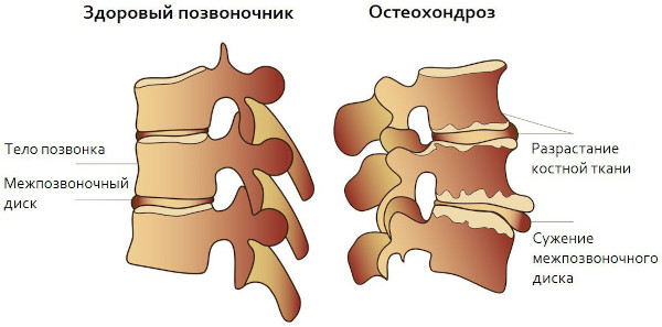 Остеохондроз: степени 1-2-3, стадии, виды, классификация по периодам