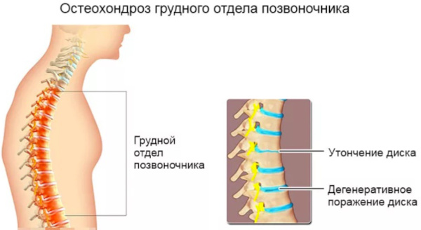 Остеохондроз: степени 1-2-3, стадии, виды, классификация по периодам