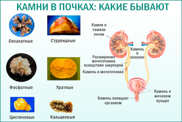 Почему моча желтая, ярко желтого лимонного цвета у женщин. Причины