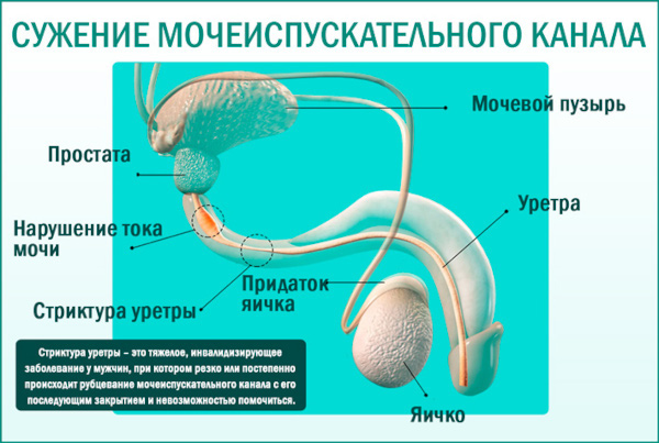 Подтекание мочи у мужчин после мочеиспускания. Причины и лечение