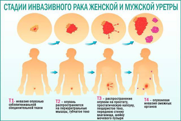 Подтекание мочи у мужчин после мочеиспускания. Причины и лечение