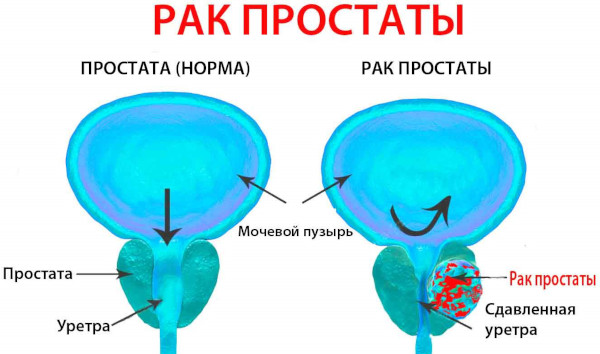 Подтекание мочи у мужчин после мочеиспускания. Причины и лечение