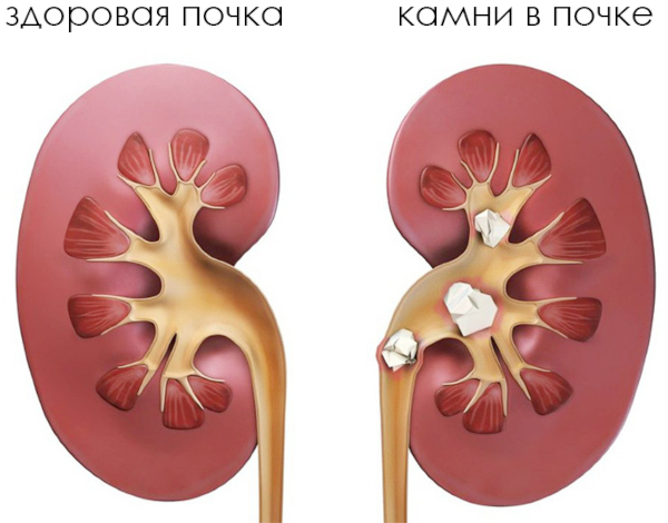 Подтекание мочи у мужчин после мочеиспускания. Причины и лечение