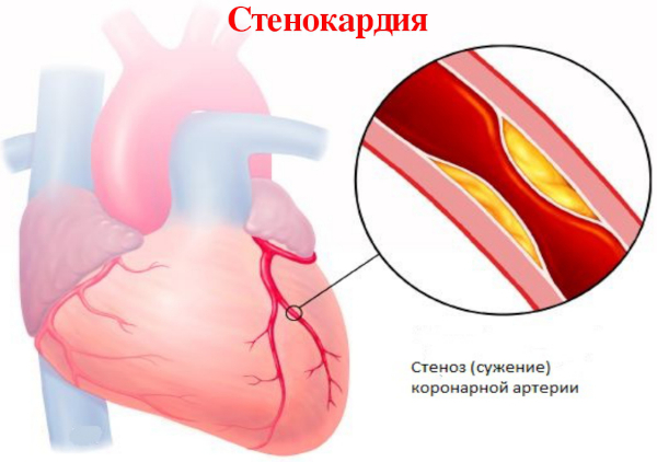 Противозачаточный имплант (подкожный контрацептив) для женщин. Цена, отзывы