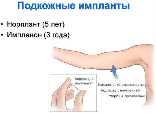 Противозачаточный имплант (подкожный контрацептив) для женщин. Цена, отзывы