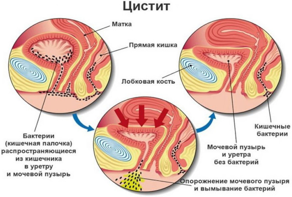 Противозачаточный имплант (подкожный контрацептив) для женщин. Цена, отзывы