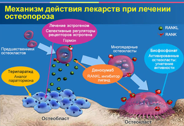 Регионарный остеопороз. Что это такое, лечение