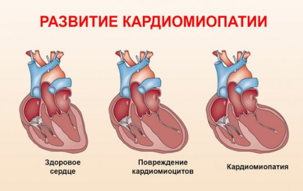 ТТГ низкий Т4 высокий. Диагноз, что это значит, как лечить