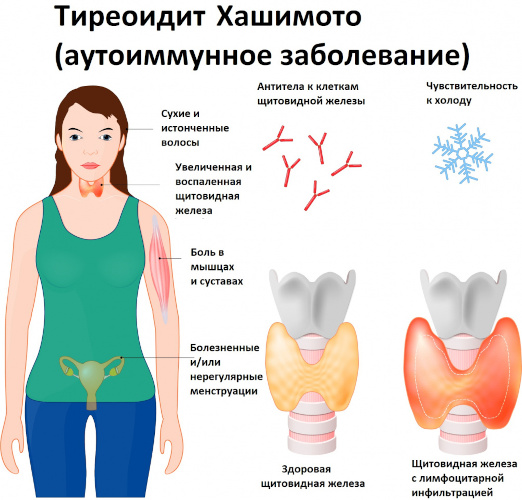 ТТГ низкий Т4 высокий. Диагноз, что это значит, как лечить